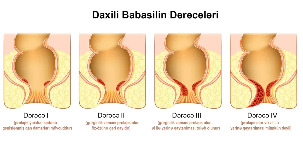 Daxili Babasilin Dərəcələri