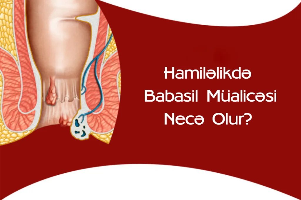 Hamiləlikdə Babasil Müalicəsi Necə Olur?