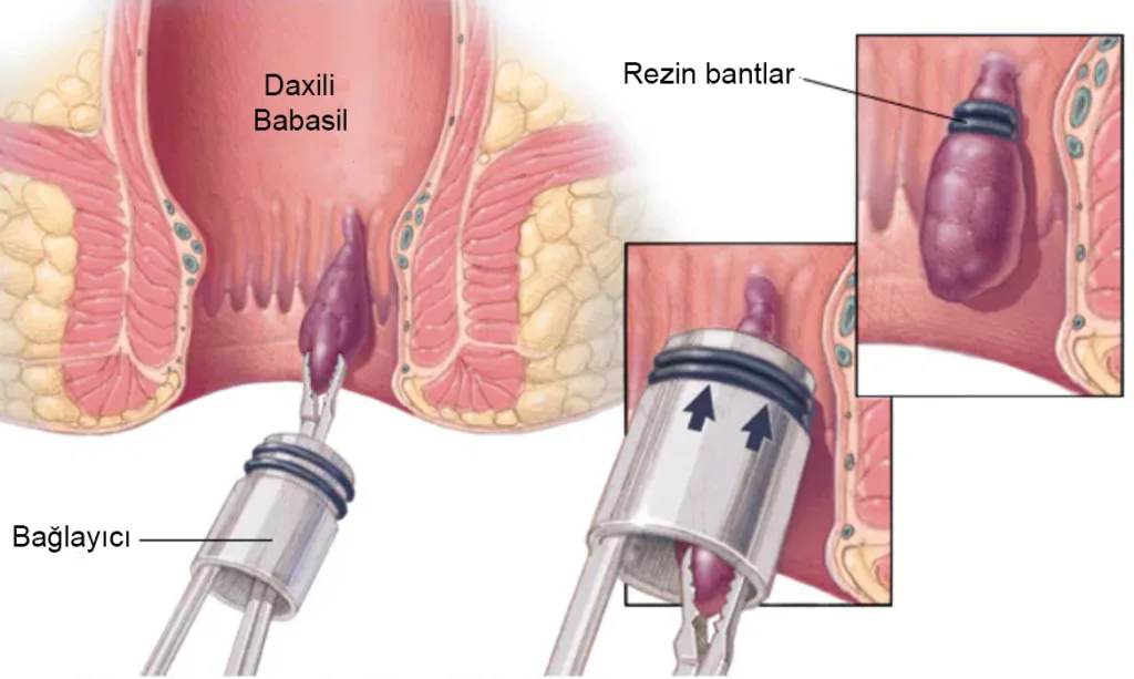 Rezin Bant Metodu İlə Bağlama (BandLigasyon)