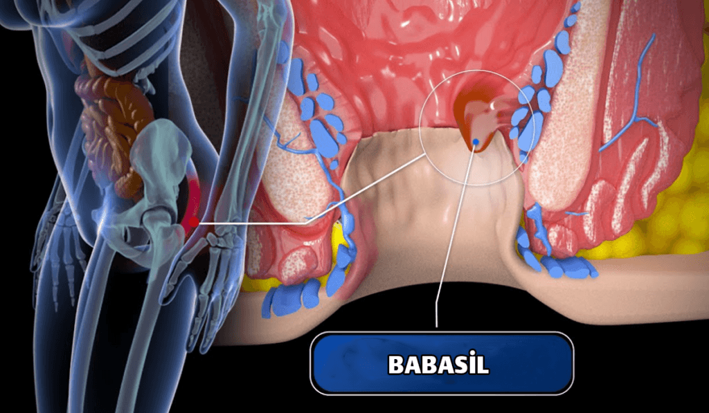 Babasil əməliyyatı ⚕️ Babasil (hemoroid) əməliyyatı necə edilir?